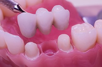 Illustration of a bridge on natural teeth