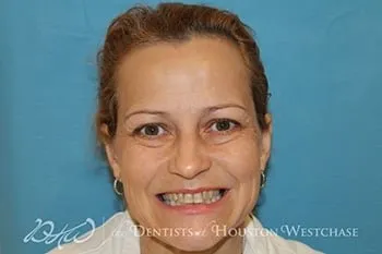 Full upper cosmetic reconstruction