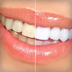 Before and After comparison with teeth whitening