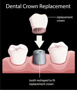 Illustration of a crown made for an implant