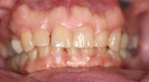 Before Anterior Crowns