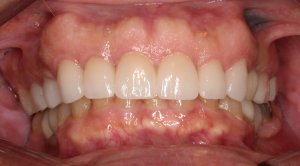 After anterior crowns