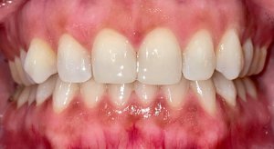 After Dental Bonding on Anterior Upper Teeth