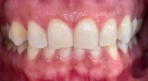Before Dental Bonding on Anterior Upper Teeth