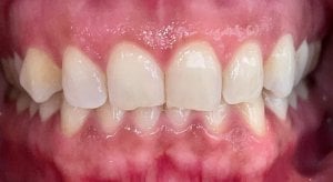 Before Dental Bonding on Anterior Upper Teeth