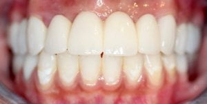 Crowns bridges whitening After Close Up