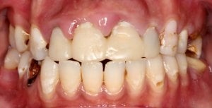 Crowns bridges whitening Before Close up