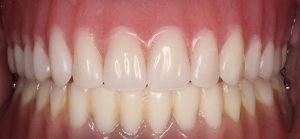 after dentures