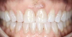 after invisalign