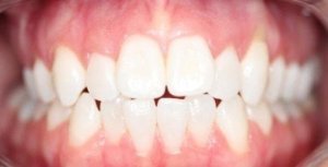 after invisalign