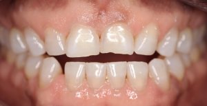 before invisalign