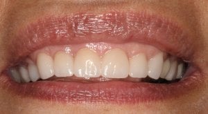 dental crowns after