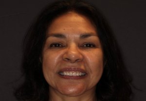 after dental crowns