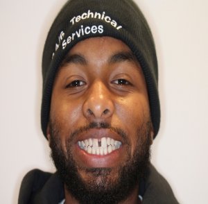 before invisalign