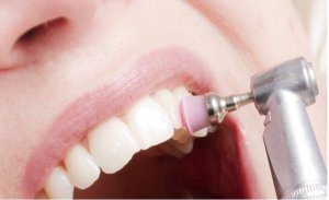 person's mouth getting its teeth polished